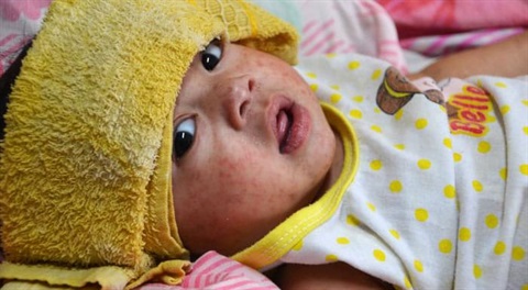measles cdc_home-feature-sick-child.jpg