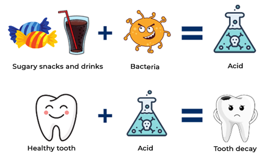 Illustration showing sugary foods to tooth cavity